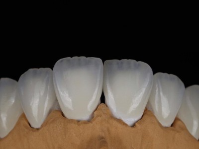 深圳固定烤瓷义齿3D数字化打印模型公司接国外订单图2