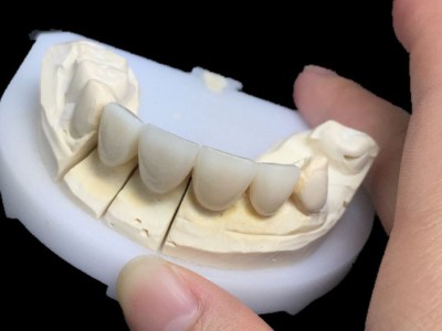 深圳义齿公司,固定义齿,义齿加工厂  二氧化锆全瓷牙