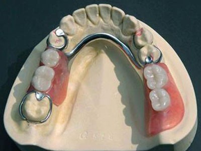 深圳活动修复义齿-定制式活动义齿 假牙厂家-义齿 假牙厂家