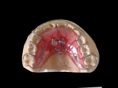 深圳定制式牙齿隐形正畸矫治器-3D隐形矫正-隐形牙套矫治