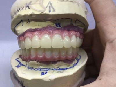 深圳种植牙Dental Implant外贸出口图2