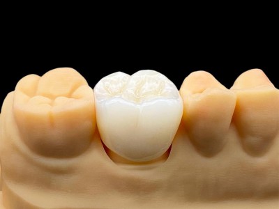 种植牙Dental Implant外贸出口